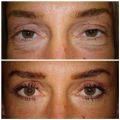 Antes e Depois - Blefaroplastia