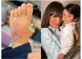 Fernanda Lacerda alerta mães após filho ser diagnosticado com escabiose 